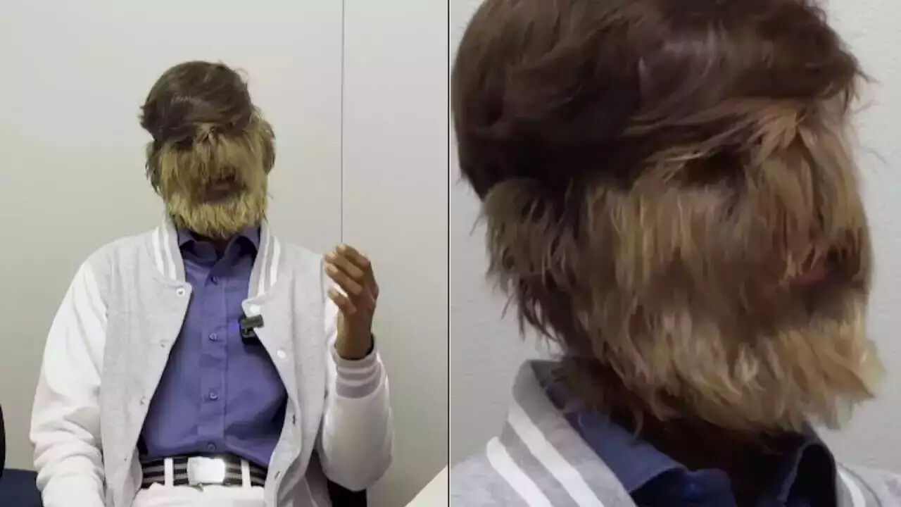 Dünyanın en kıllı yüzüne sahip genç Guinness Rekorlar Kitabı'na girdi! Dünyanın en kıllı yüzüne sahip genç Guinness Rekorlar Kitabı'na girdi! - 1. Resim