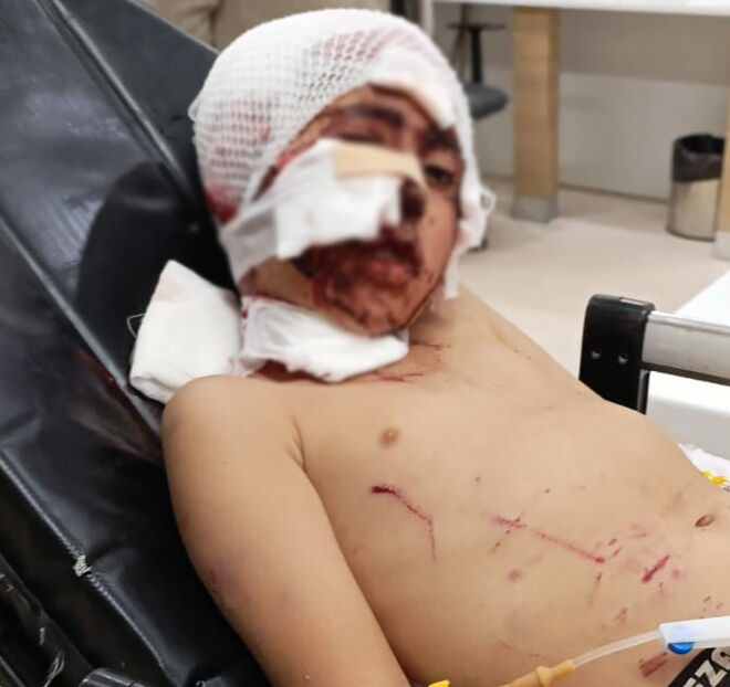 Erzurum’da başıboş köpekler, küçük çocuğun yüzünü parçaladı Erzurum’da başıboş köpekler, küçük çocuğun yüzünü parçaladı - 1. Resim