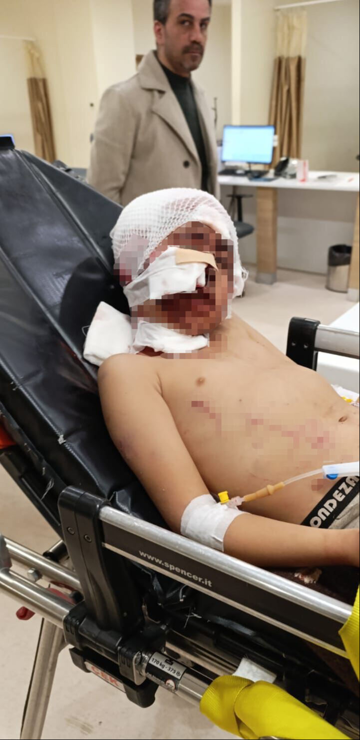 Sokak köpekleri çocuğunun yüzünü parçaladı! Acılı babanın feryadı yürek yaktı Sokak köpekleri çocuğunun yüzünü parçaladı! Acılı babanın feryadı yürek yaktı - 2. Resim