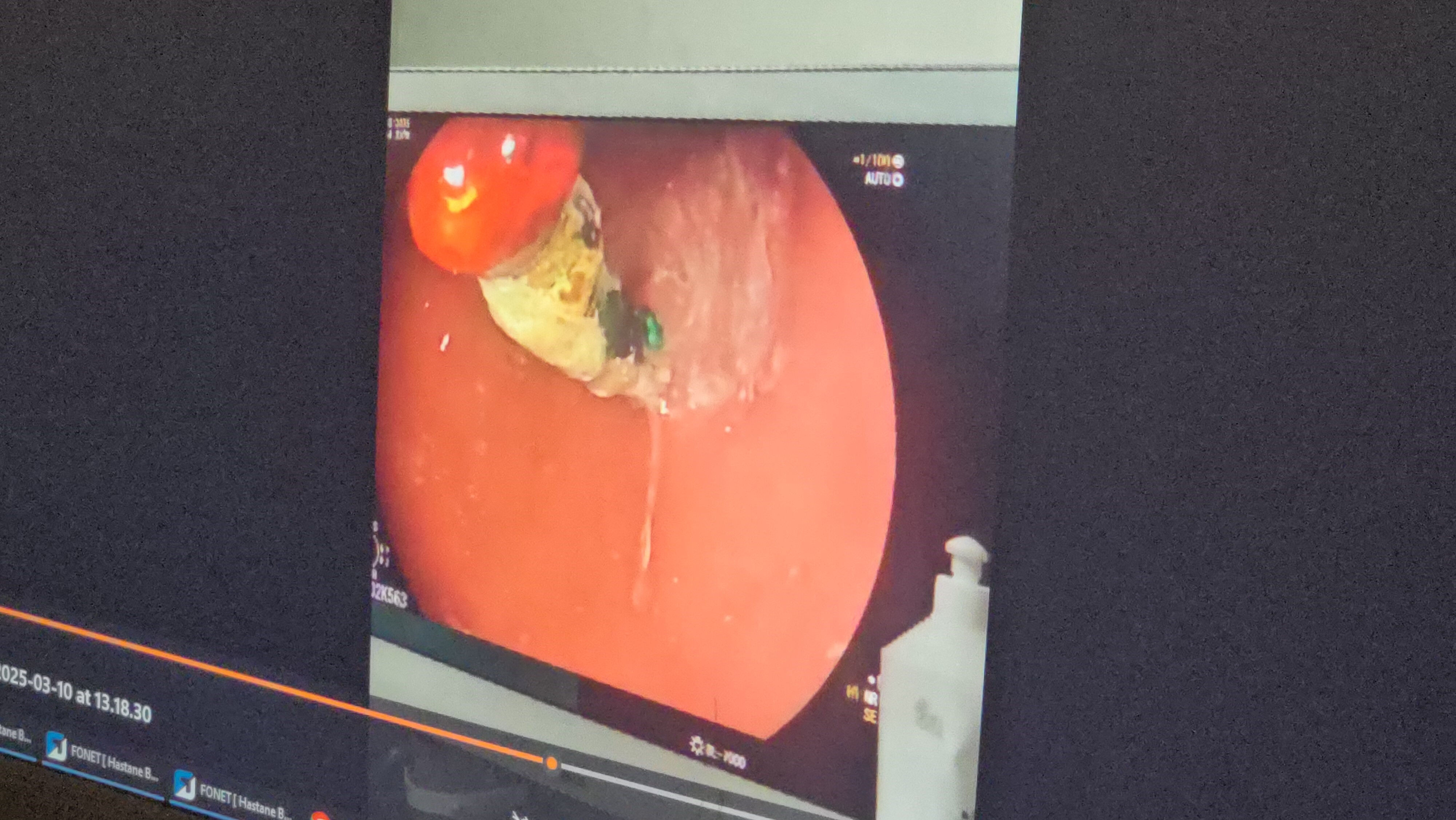 Karın ağrısı şikayetiyle gitti! Çocuğun midesinden çıkanlar doktorları bile hayrete düşürdü Karın ağrısı şikayetiyle gitti! Çocuğun midesinden çıkanlar doktorları bile hayrete düşürdü - 3. Resim