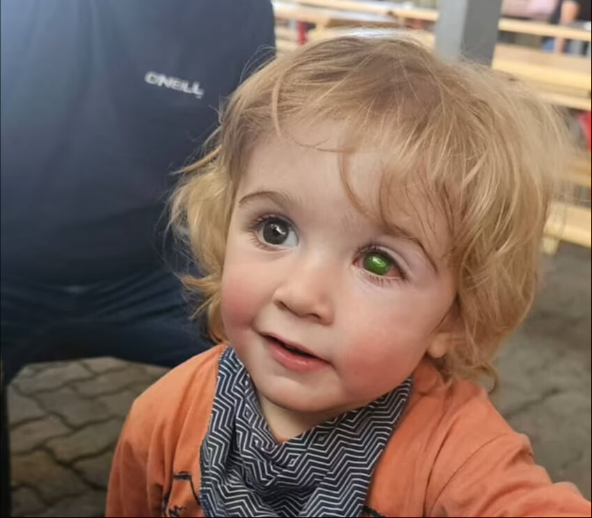 2 yaşındaki çocuk faciayı yaşadı! Bir öpücükle gözünden oldu - 2. Resim