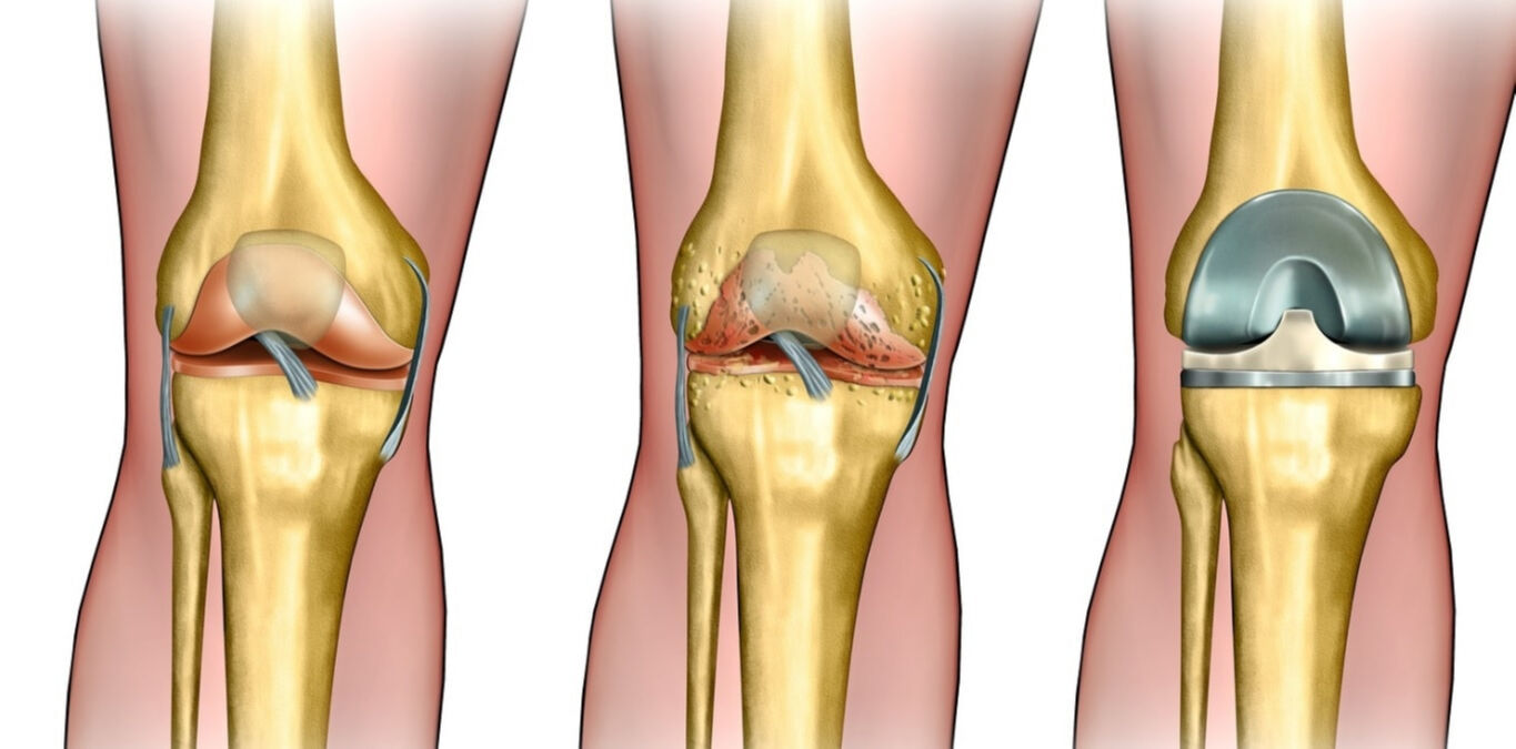 Kemiklerin fısıltısı: Artrozun (Eklem kireçlenmesi) sessiz saldırısı! - 2. Resim
