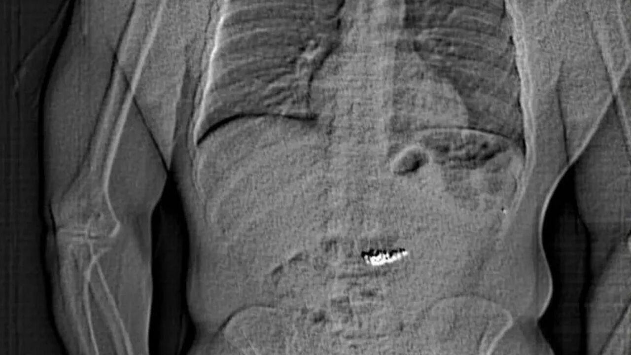 Midesinde günlerce 29 milyon liralık servet taşıdı! O küpeler mağazaya iade edildi - 1. Resim