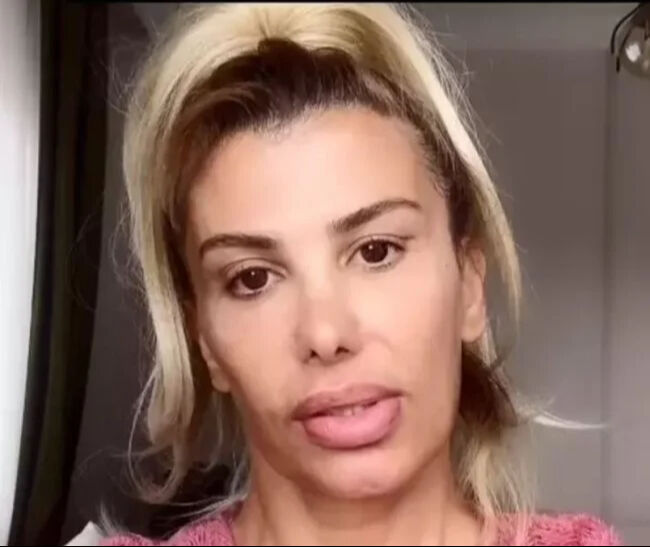 Botokstan zehirlenmişti! Şarkıcı Hatice'nin son hali korkuttu: Yaşadıklarını tek tek anlattı - 1. Resim