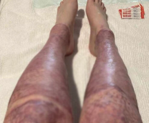 Tatil için gitmişti: Hem vücudu yandı, hem ailesini kaybetti - 3. Resim