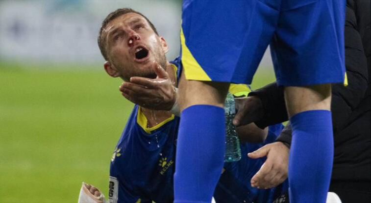 Dzeko neden maske takıyor, sakatlandı mı? Edin Dzeko sakatlık durumu açıklaması geldi! - 3. Resim