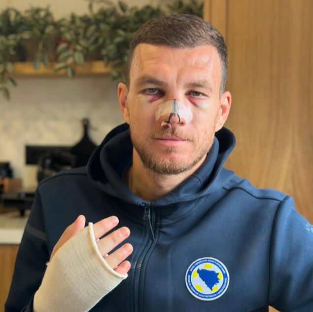 Dzeko neden maske takıyor, sakatlandı mı? Edin Dzeko sakatlık durumu açıklaması geldi! - 2. Resim