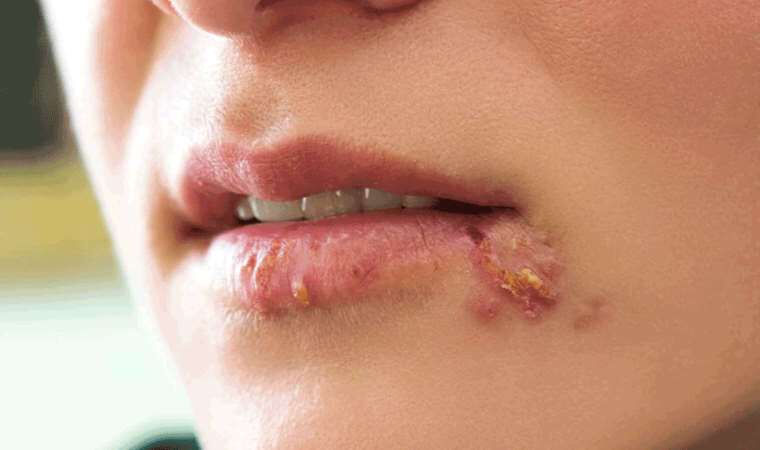 Uçuk deyip geçmeyin, bakın neye sebep oluyor! Duyunca kulaklarınıza inanamayacaksınız - 1. Resim