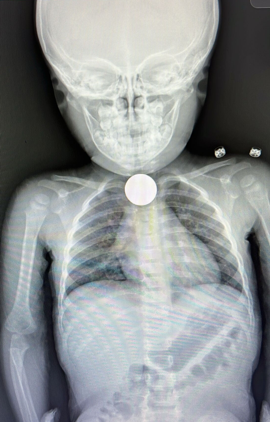 1,5 yaşındaki bebek faciayı yaşadı! Yemek borusundan çıkan şoke etti 1,5 yaşındaki bebek faciayı yaşadı! Yemek borusundan çıkan şoke etti - 2. Resim