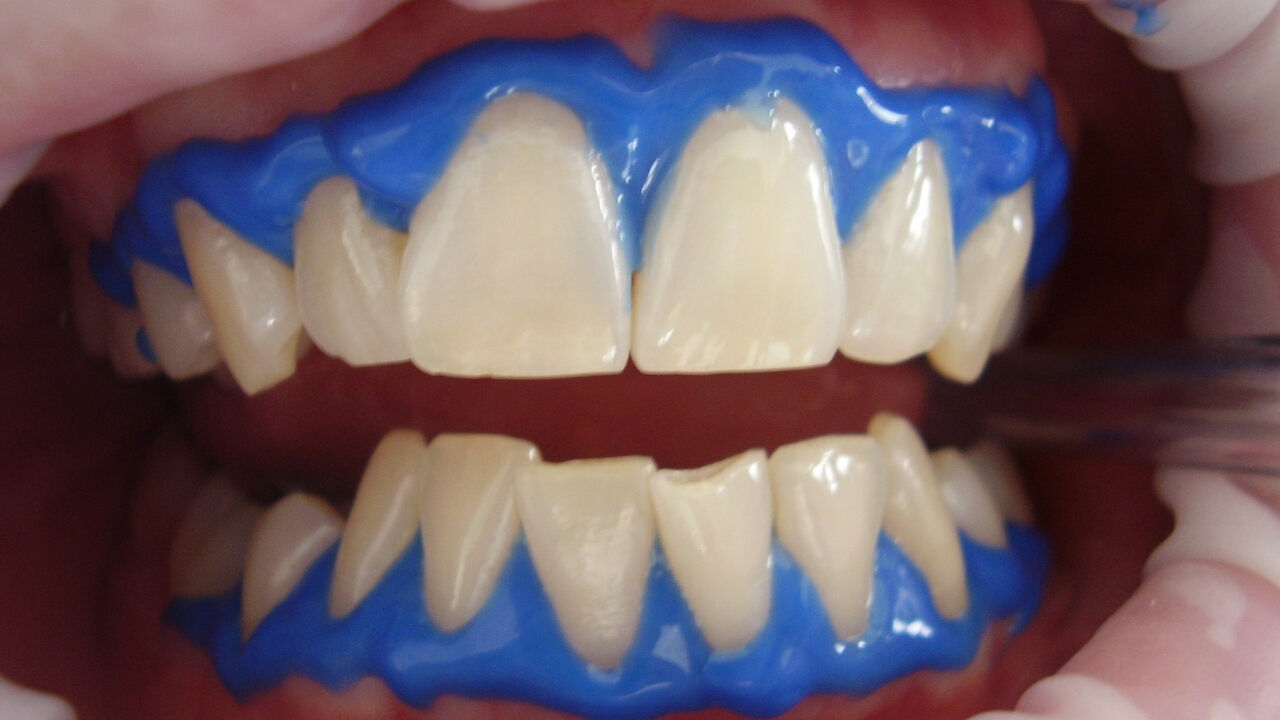 Diş sararması kaçınılmaz! Uzmanlar uyarıyor, bunlara dikkat etmiyorsanız beyaz dişlere veda edin - 5. Resim