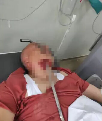 Hatay'da dehşete düşüren olay! Yüzüne demir saplanan işçi faciayı yaşadı Hatay'da dehşete düşüren olay! Yüzüne demir saplanan işçi faciayı yaşadı - 1. Resim