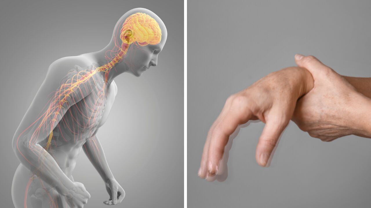 Parkinson hastalığı beslenmeden geçiyor! - 1. Resim