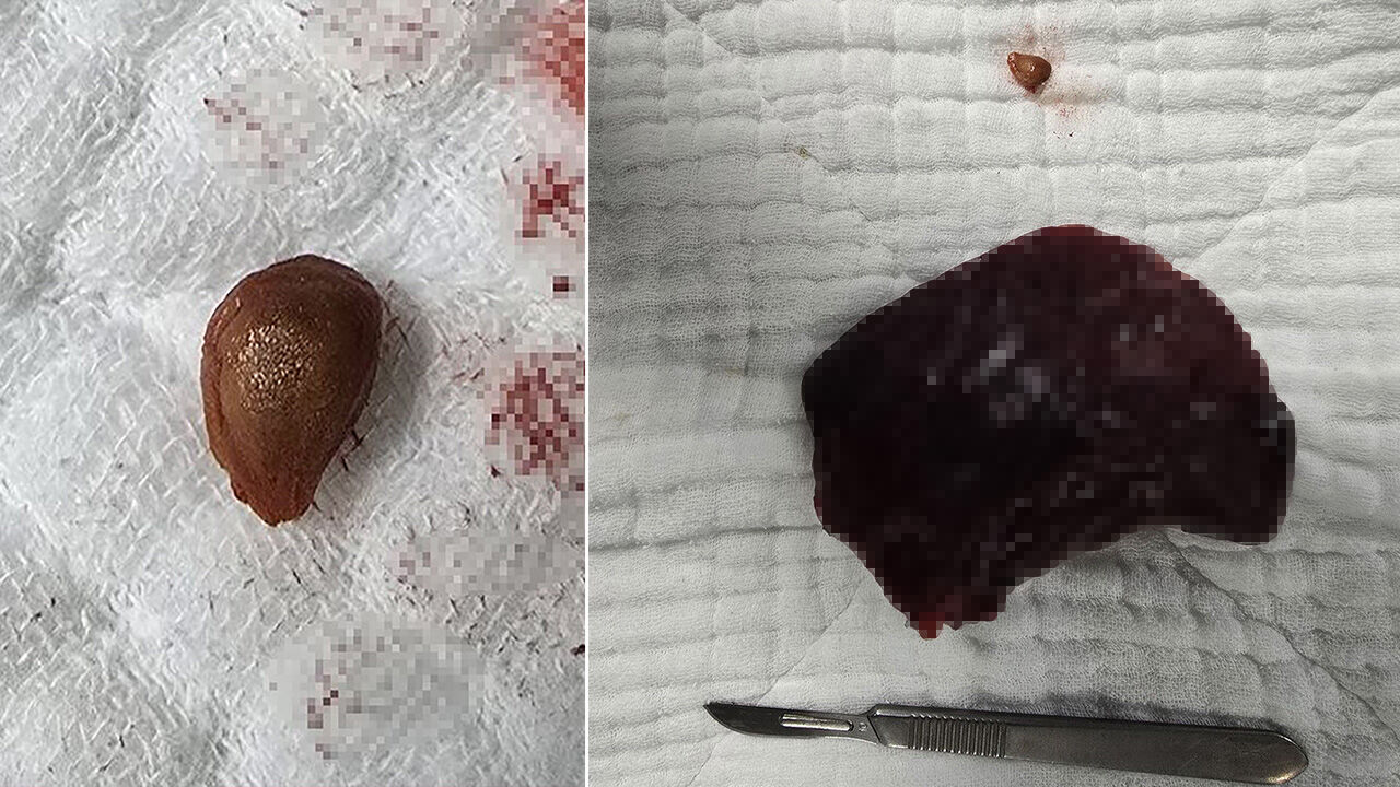 Kurtuldum zannetti, akciğerinden oldu! Bu çekirdek canından ediyordu - 1. Resim