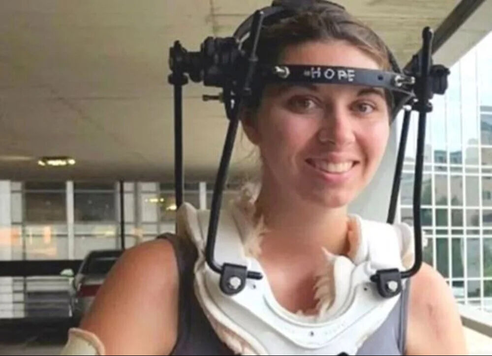 Beden eğitimi dersinde faciayı yaşadı! Kafatası omurgasından ayrıldı: 37 ameliyat geçirdi - 2. Resim