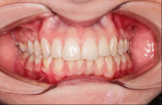 Dolgu ve implant tarih oluyor! Diş sağlığında çığır açan gelişme: Kolaylıkla entegre olup kendini onarabiliyor Dolgu ve implant tarih oluyor! Diş sağlığında çığır açan gelişme: Kolaylıkla entegre olup kendini onarabiliyor - 1. Resim