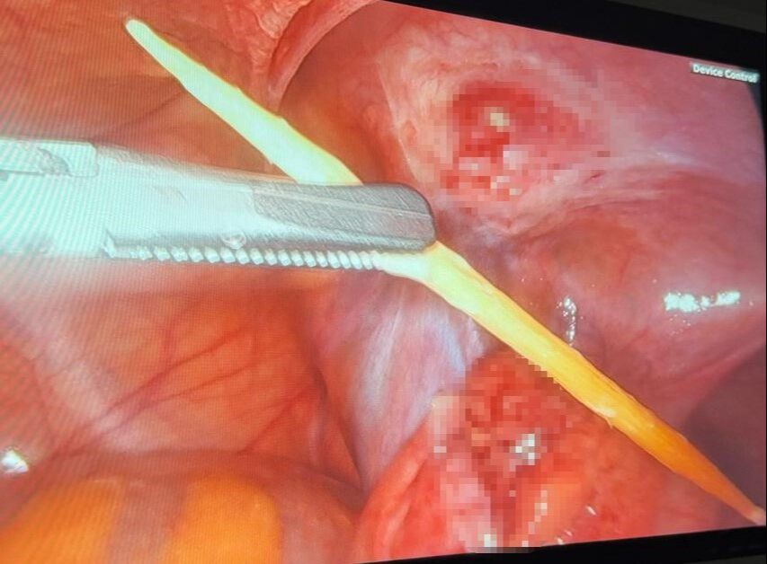 Cismi gören doktorlar bakakaldı... Kalınbağırsağından çıkardılar: Bunu nasıl yaptın çocuk! Cismi gören doktorlar bakakaldı... Kalınbağırsağından çıkardılar: Bunu nasıl yaptın çocuk! - 1. Resim