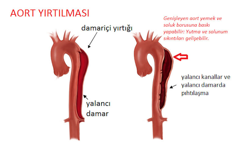 Aort damarı yırtılması (aort diseksiyonu) nedir, neden olur? Vücuttaki en büyük damar aortun önemi gündemde! Aort damarı yırtılması (aort diseksiyonu) nedir, neden olur? Vücuttaki en büyük damar aortun önemi gündemde! - 2. Resim