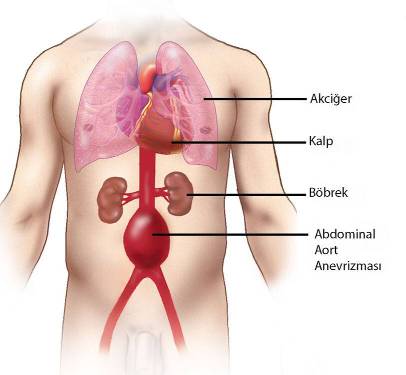 Aort damarı yırtılması (aort diseksiyonu) nedir, neden olur? Vücuttaki en büyük damar aortun önemi gündemde! Aort damarı yırtılması (aort diseksiyonu) nedir, neden olur? Vücuttaki en büyük damar aortun önemi gündemde! - 1. Resim