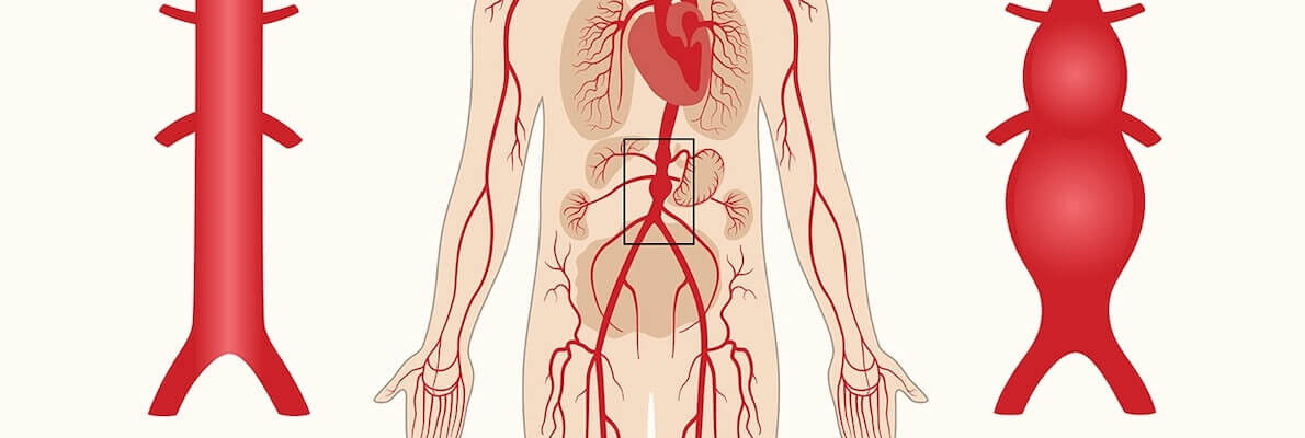Aort damarı yırtılması (aort diseksiyonu) nedir, neden olur? Vücuttaki en büyük damar aortun önemi gündemde! Aort damarı yırtılması (aort diseksiyonu) nedir, neden olur? Vücuttaki en büyük damar aortun önemi gündemde! - 4. Resim