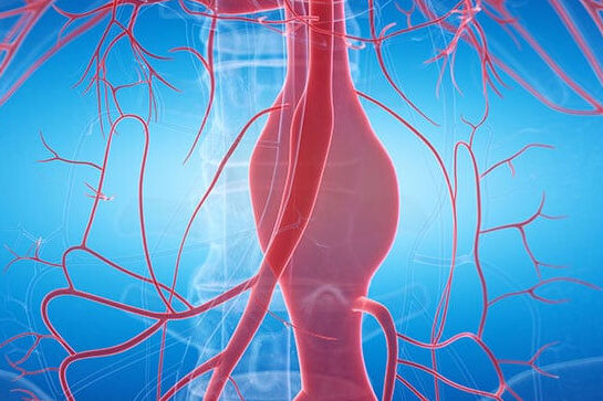 Sırrı Süreyya Önder'den sonra tekrar gündem! Aort yırtılması kalp krizi ve felçle sonuçlanabilir - 3. Resim