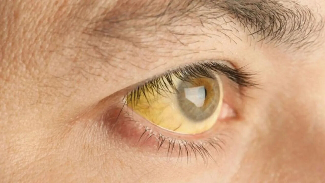 Ülkede acil durum ilan edildi! Humma hastalığından 34 ölüm - 4. Resim