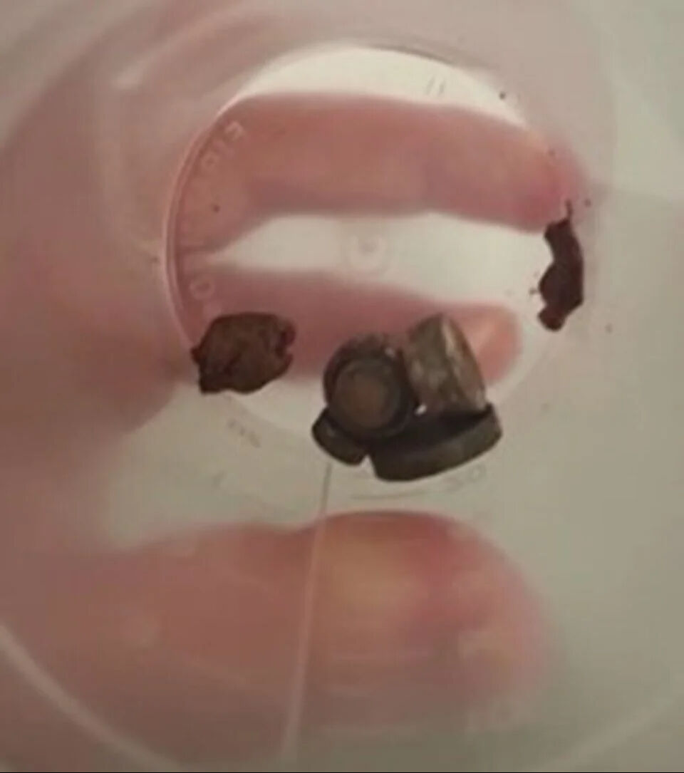 2 yaşındaki çocuğun yuttukları hayrete düşürdü! Bağırsakları yandı, faciayı yaşadı - 1. Resim