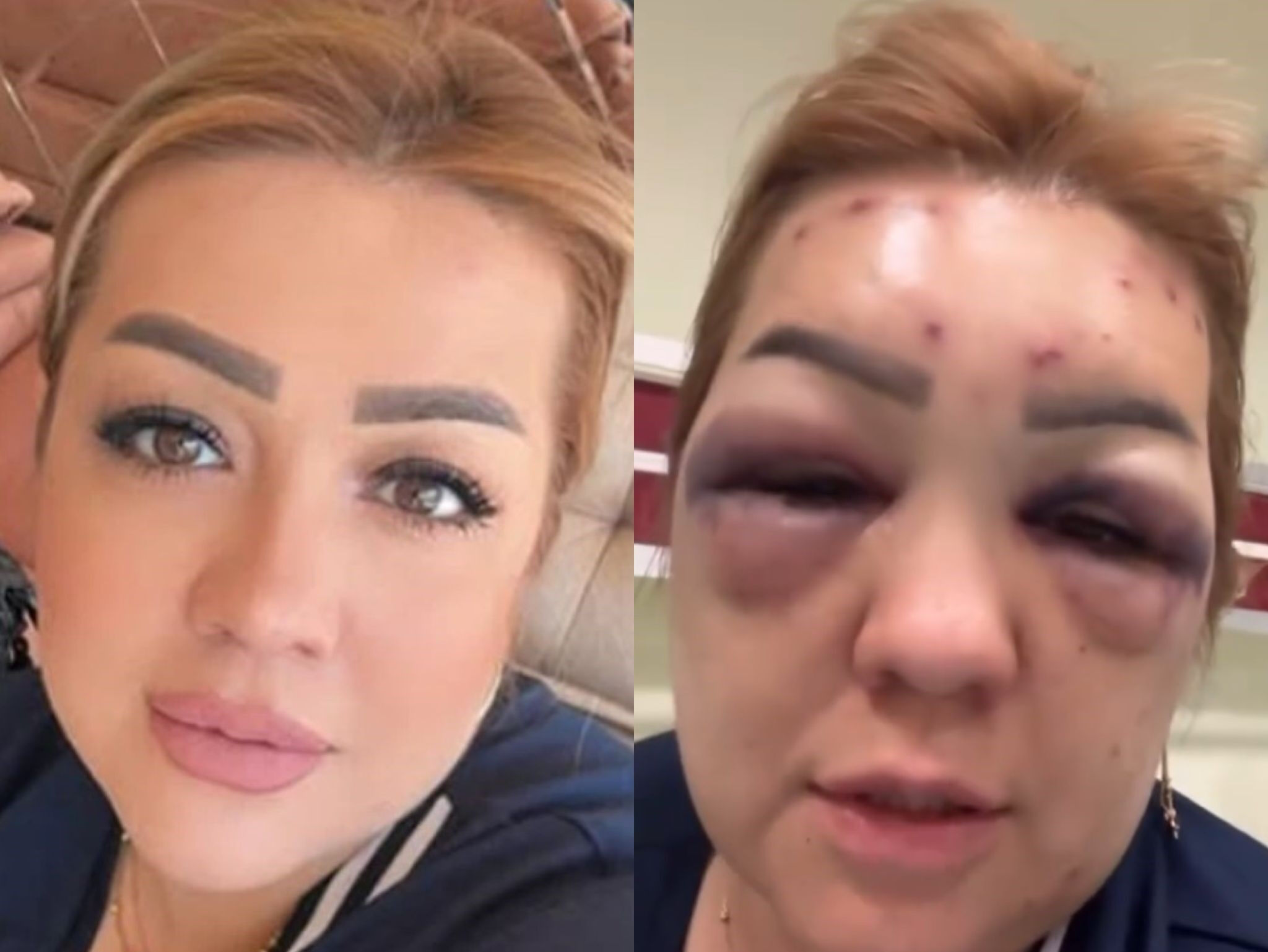 Estetik merkezi kabusu oldu: "Dayak yemedim, botoks mağduruyum" Estetik merkezi kabusu oldu: "Dayak yemedim, botoks mağduruyum" - 1. Resim