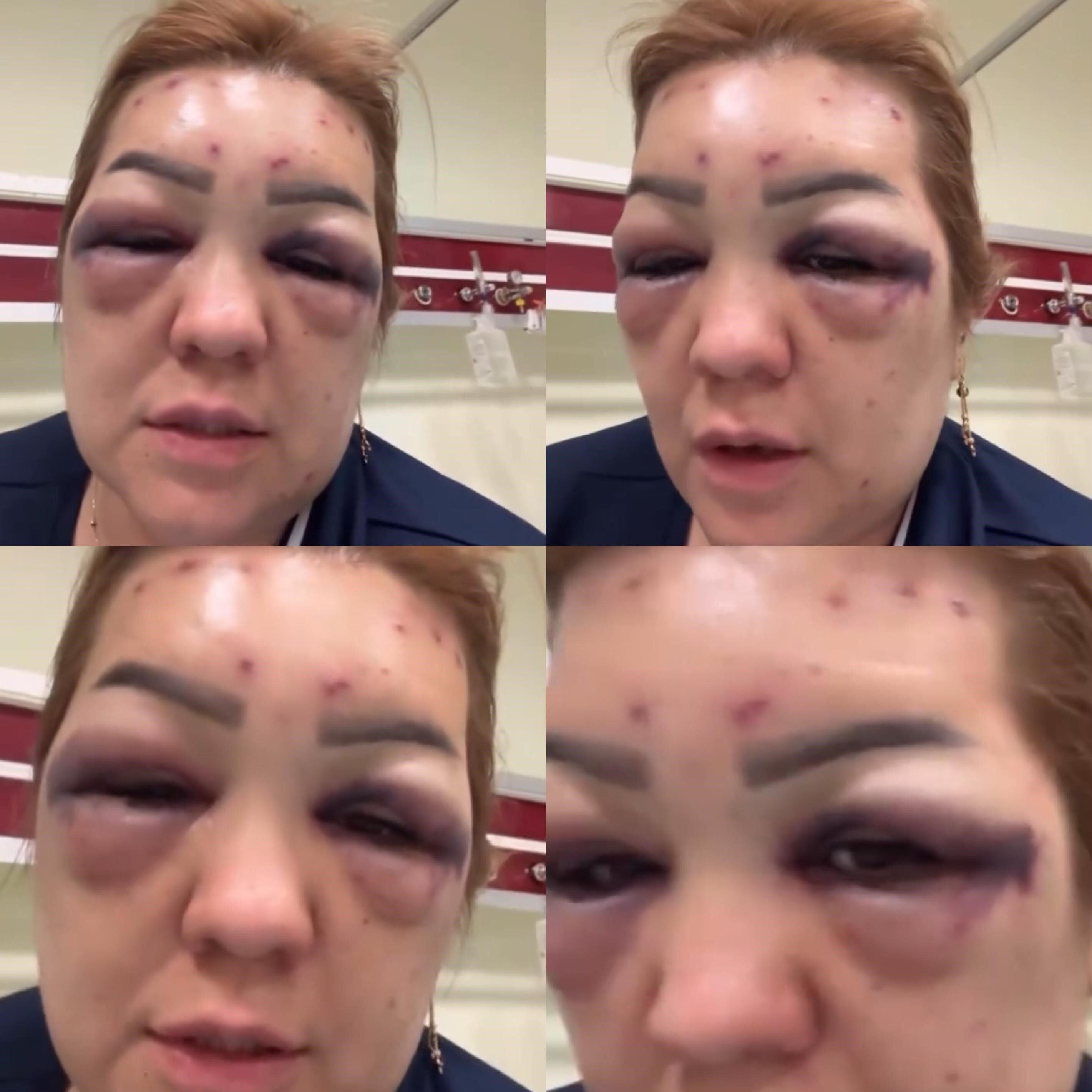 Estetik merkezi kabusu oldu: "Dayak yemedim, botoks mağduruyum" Estetik merkezi kabusu oldu: "Dayak yemedim, botoks mağduruyum" - 2. Resim