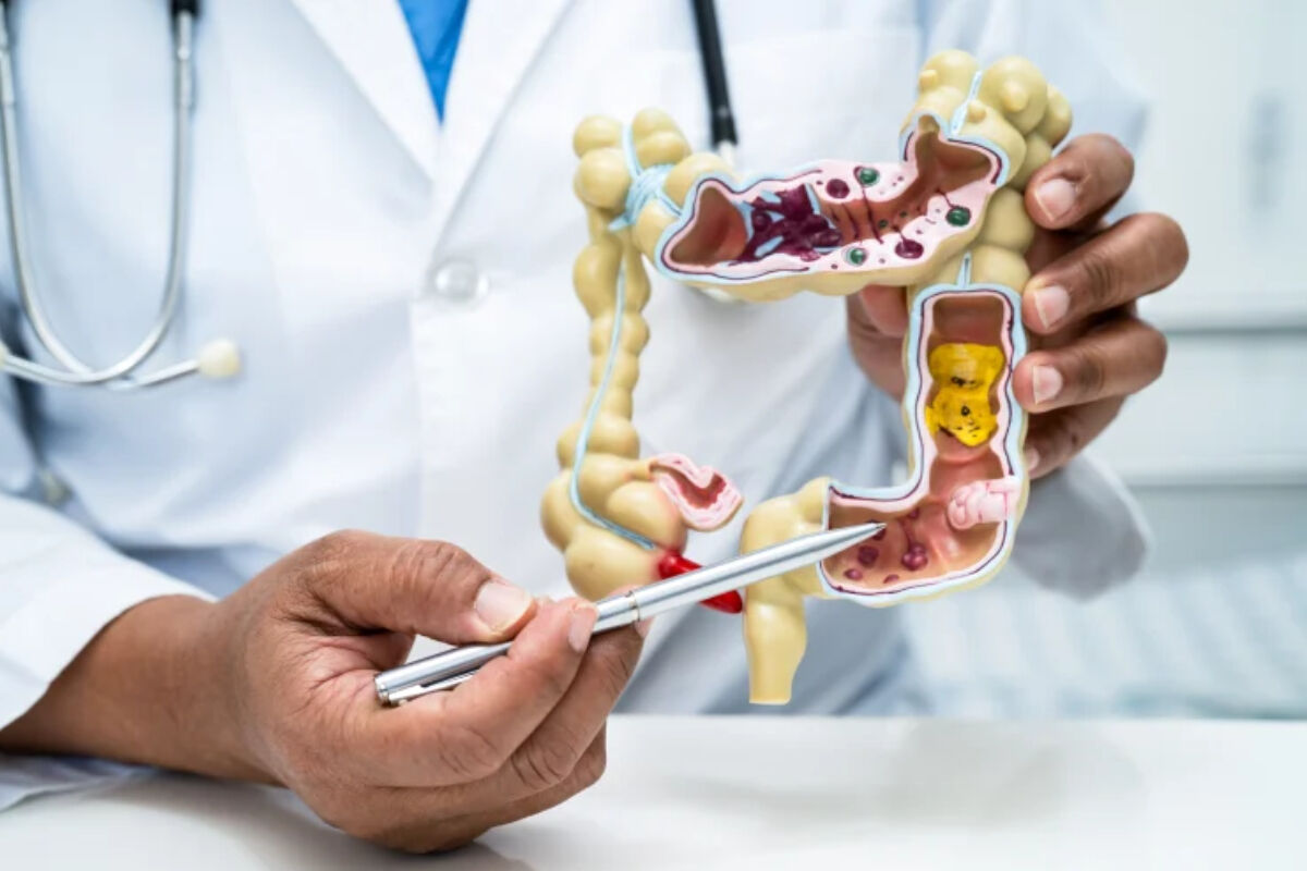 Kolon kanseri artış gösteriyor: Bu vitamin eksikliği nedeni olabilir! - 1. Resim