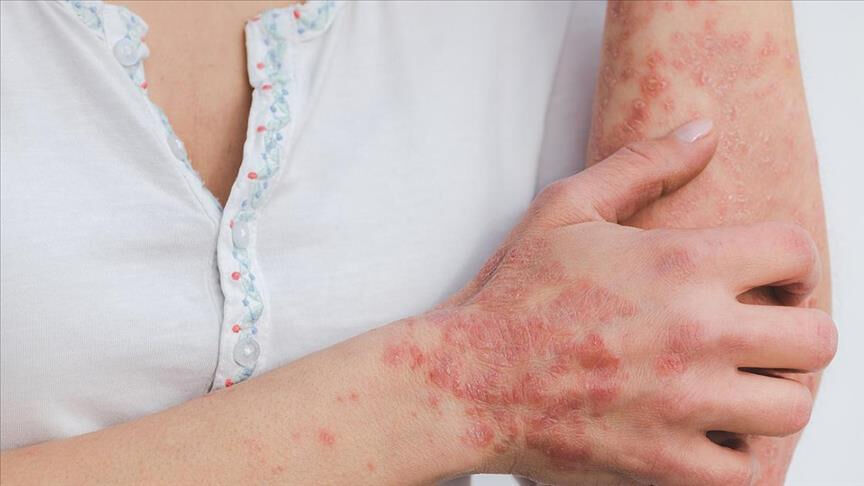 Uzmandan uyarı geldi! 'Y&uuml;zdeki bir kızarıklık' deyip ge&ccedil;meyin: Meğer... - 3. Resim