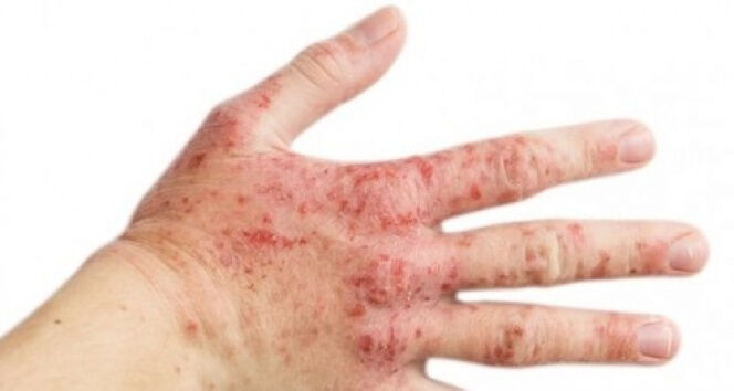 Uzmandan uyarı geldi! 'Y&uuml;zdeki bir kızarıklık' deyip ge&ccedil;meyin: Meğer... - 4. Resim