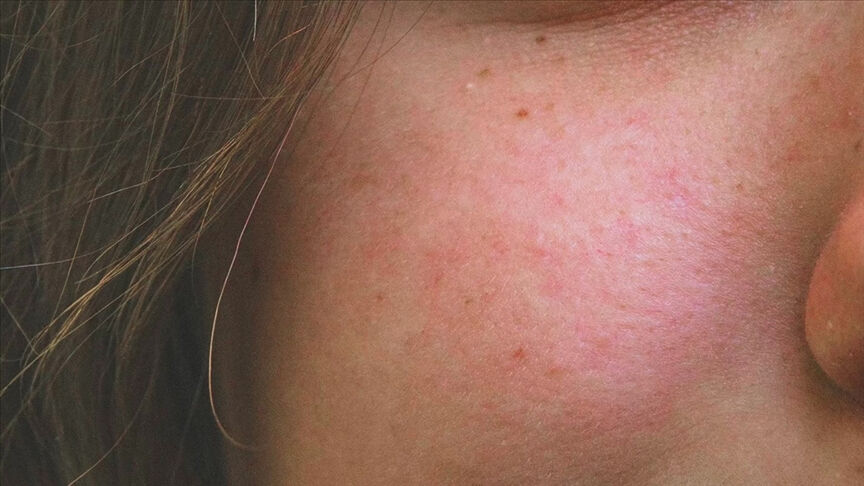 Uzmandan uyarı geldi! 'Y&uuml;zdeki bir kızarıklık' deyip ge&ccedil;meyin: Meğer... - 2. Resim