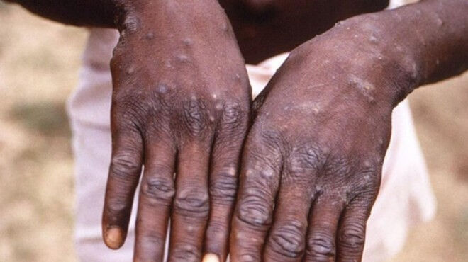 Vakalar artıyor, bir ülke alarmda! Hem hayvan hem de insanlardan bulaşıyor - 1. Resim