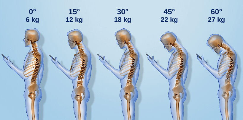 Teknoloji çağının yaygın rahatsızlığı: Boyun düzleşmesi neden olur, nasıl tedavi edilir? Teknoloji çağının yaygın rahatsızlığı: Boyun düzleşmesi neden olur, nasıl tedavi edilir? - 1. Resim