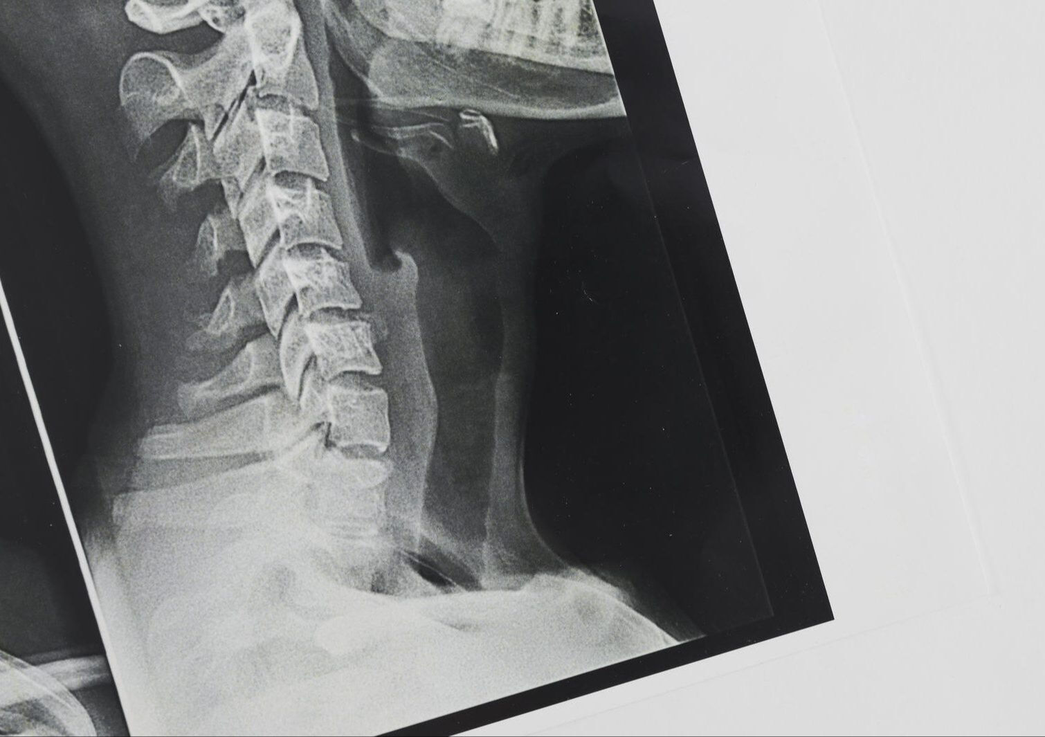 Teknoloji çağının yaygın rahatsızlığı: Boyun düzleşmesi neden olur, nasıl tedavi edilir? Teknoloji çağının yaygın rahatsızlığı: Boyun düzleşmesi neden olur, nasıl tedavi edilir? - 3. Resim