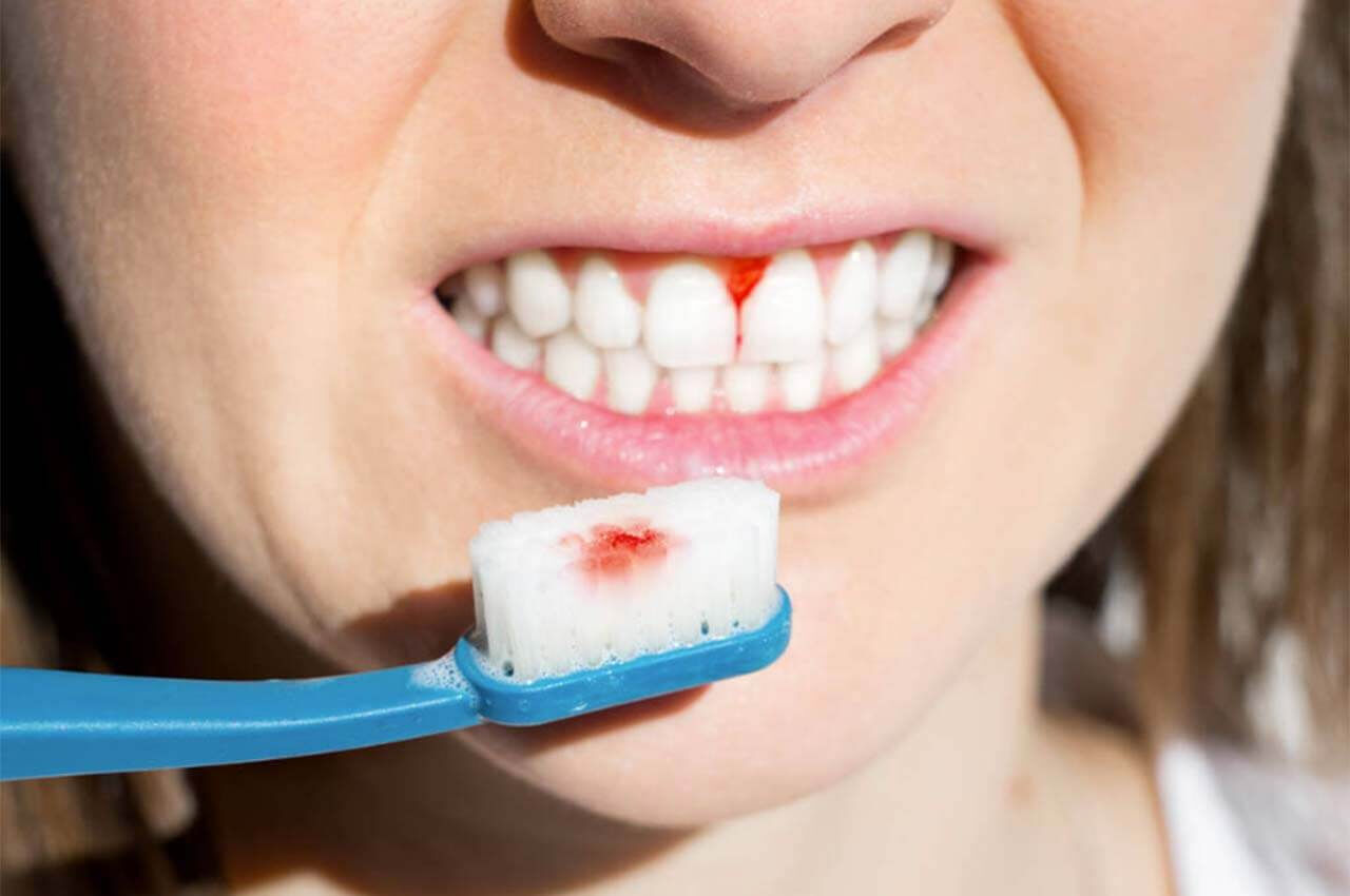 Diş eti şikayetiniz varsa dikkat: Bu kanser türünün ilk belirtisi olabilir - 1. Resim