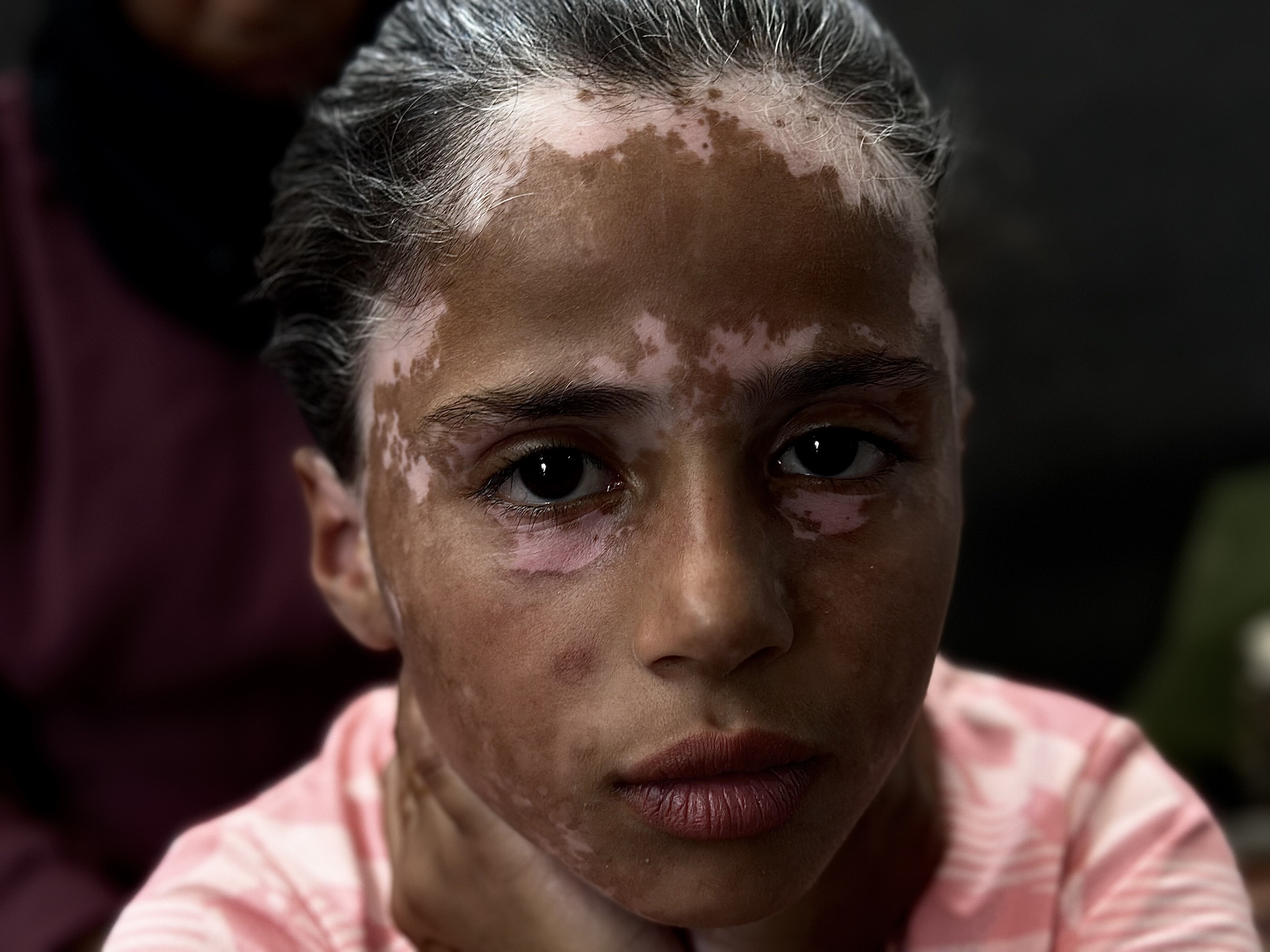 Yanı başına bombalar yağdı, korkudan hastalığa yakalandı! Gazzeli Lana yürek dağladı: Savaştan önce çok güzeldim - 3. Resim