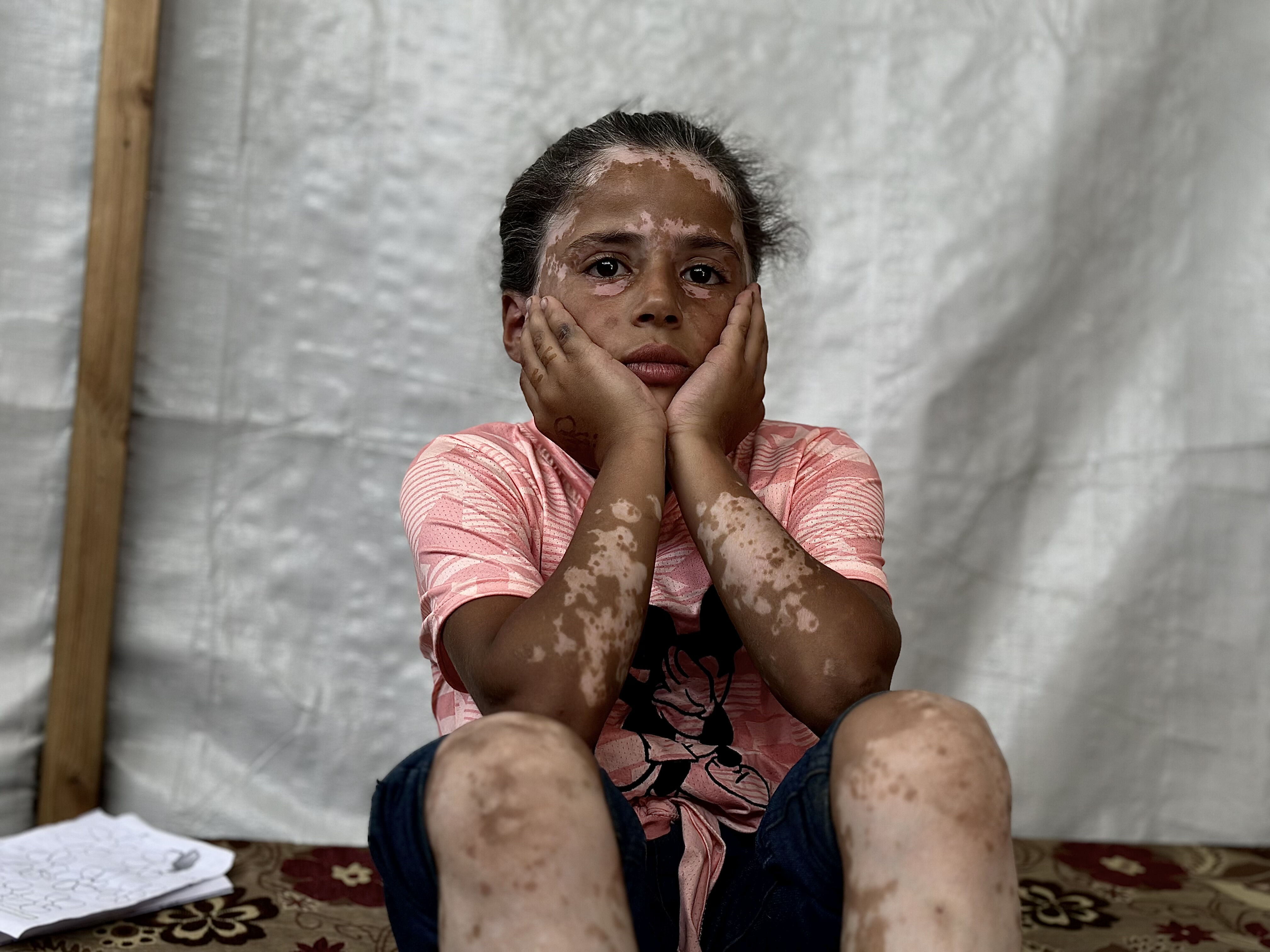 Yanı başına bombalar yağdı, korkudan hastalığa yakalandı! Gazzeli Lana yürek dağladı: Savaştan önce çok güzeldim - 1. Resim