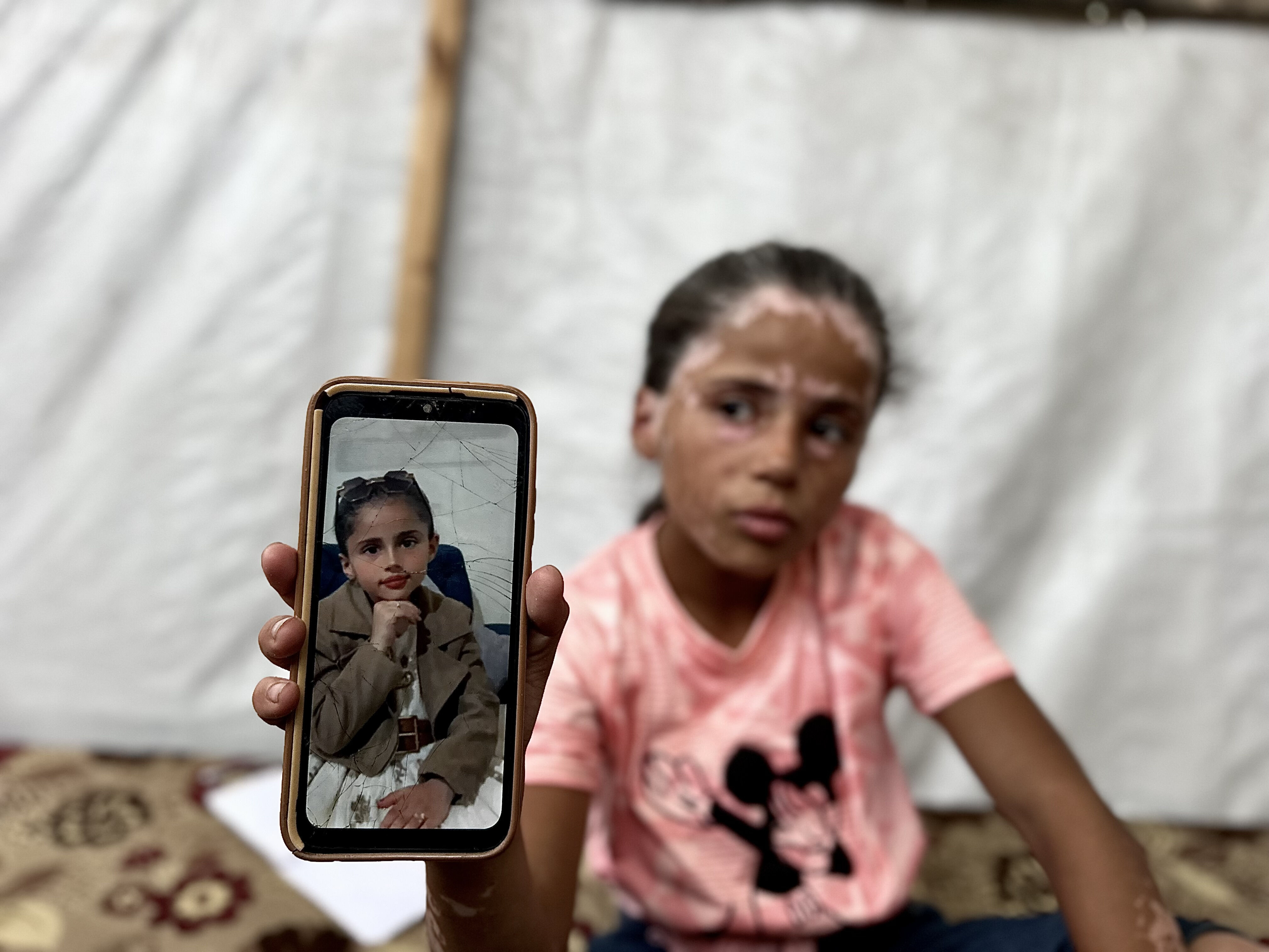 Yanı başına bombalar yağdı, korkudan hastalığa yakalandı! Gazzeli Lana yürek dağladı: Savaştan önce çok güzeldim - 5. Resim