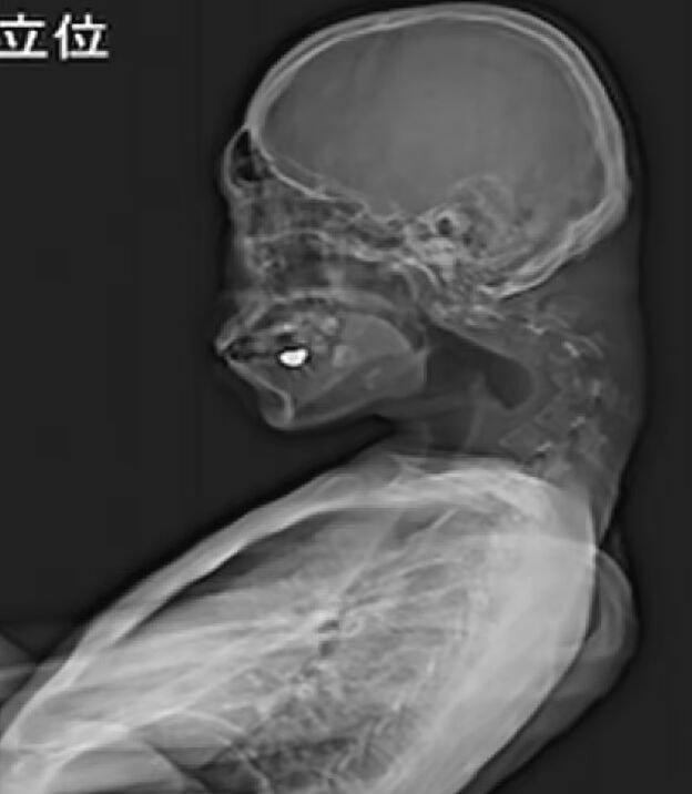 Uzun süre ekrana maruz kalanlar dikkat! Omurları yerinden oynadı, aylarca kabusu yaşadı - 3. Resim