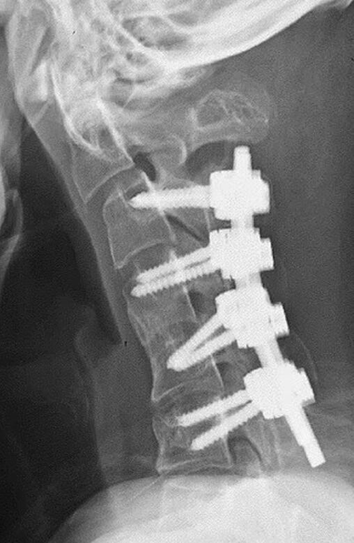 Uzun süre ekrana maruz kalanlar dikkat! Omurları yerinden oynadı, aylarca kabusu yaşadı - 2. Resim