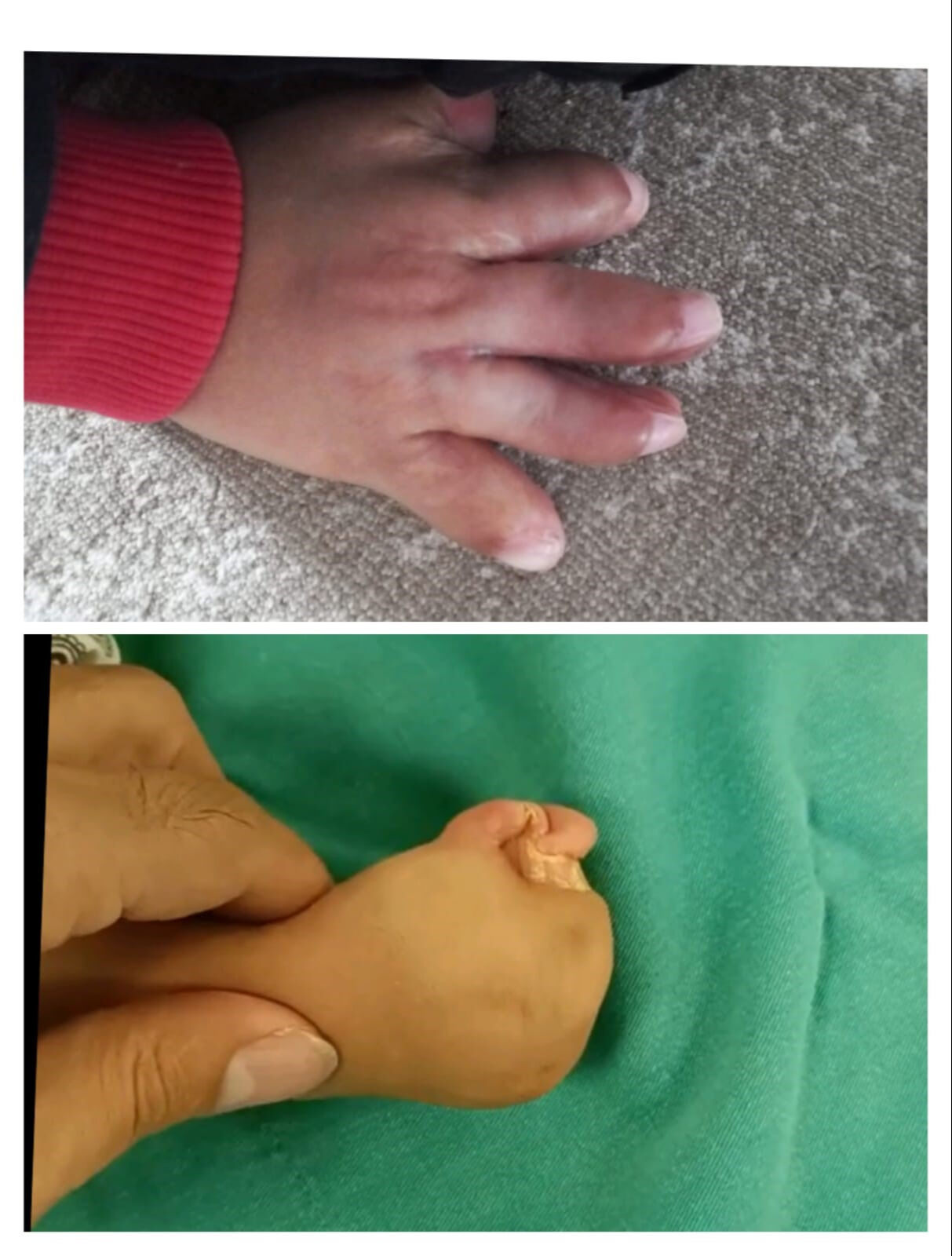 Doktorlar bile ismini bilmiyor! Aile çözümü Eskişehir'de buldu:10 parmağı açıldı - 1. Resim