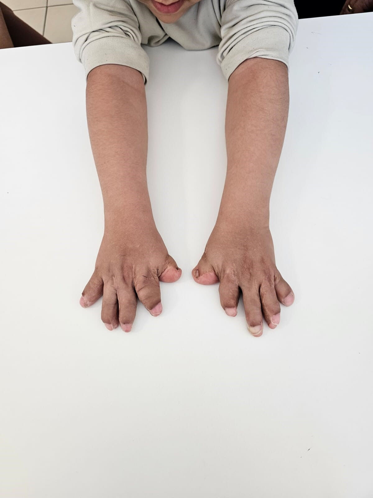 Doktorlar bile ismini bilmiyor! Aile çözümü Eskişehir'de buldu:10 parmağı açıldı - 4. Resim