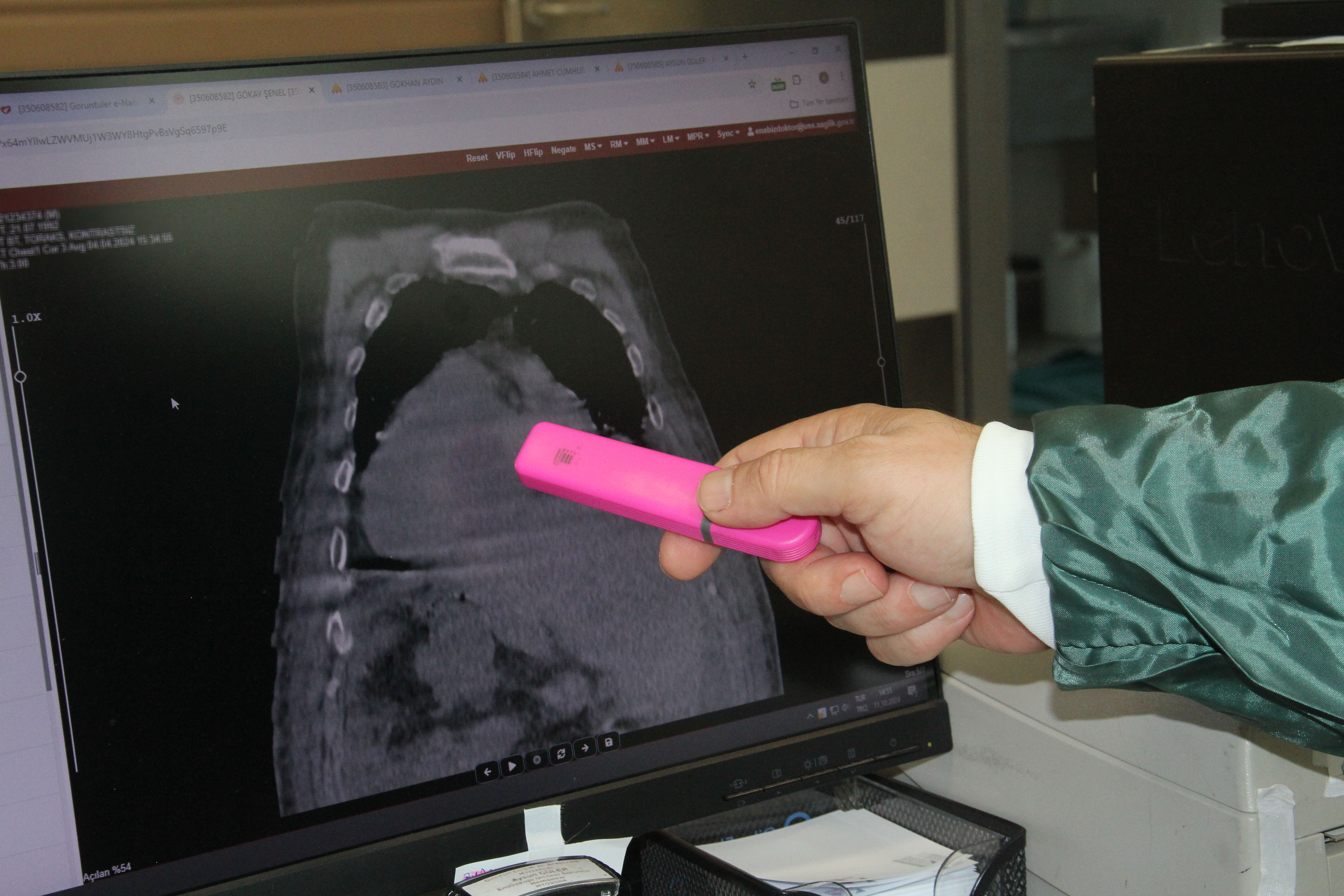 Üç hastalık bir arada! Karadeniz sendromu tıp literatürüne geçti - 1. Resim