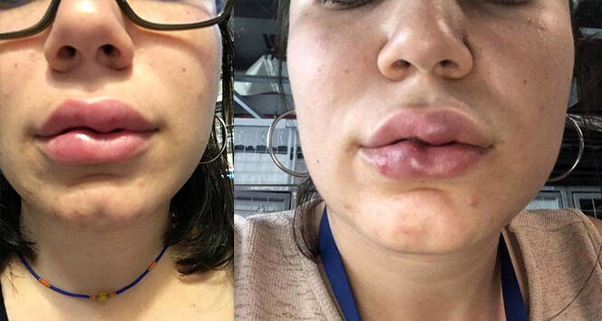 Ucuz estetik hayatınızı karartabilir: Uzmanı uyardı dudak dolgusu körlüğe neden olabilir! - 2. Resim