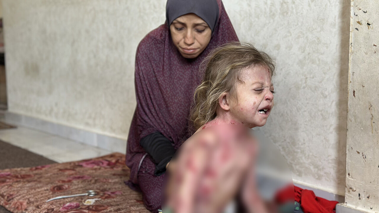 Gazze'de büyük dram! Kelebek hastası küçük kız tedavi olmayı bekliyor - 5. Resim