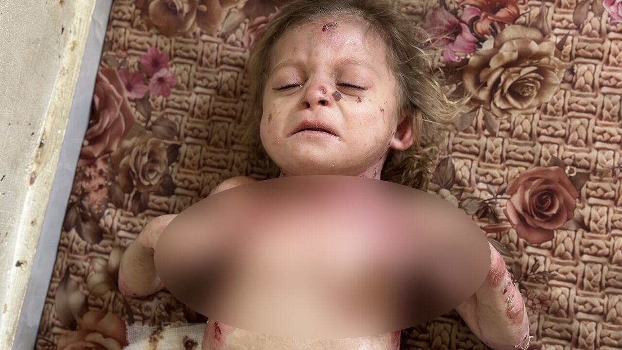 Gazze'de büyük dram! Kelebek hastası küçük kız tedavi olmayı bekliyor - 3. Resim