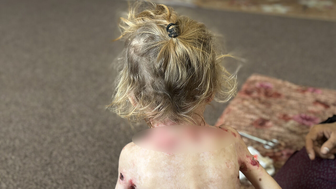 Gazze'de büyük dram! Kelebek hastası küçük kız tedavi olmayı bekliyor - 6. Resim