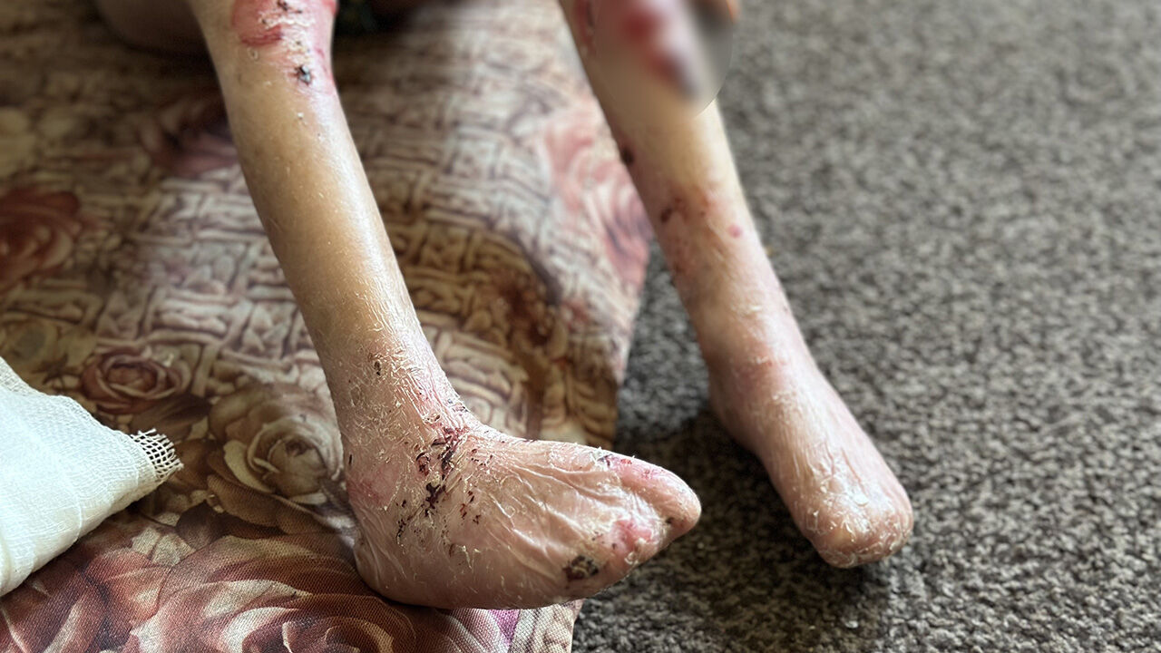 Gazze'de büyük dram! Kelebek hastası küçük kız tedavi olmayı bekliyor - 4. Resim