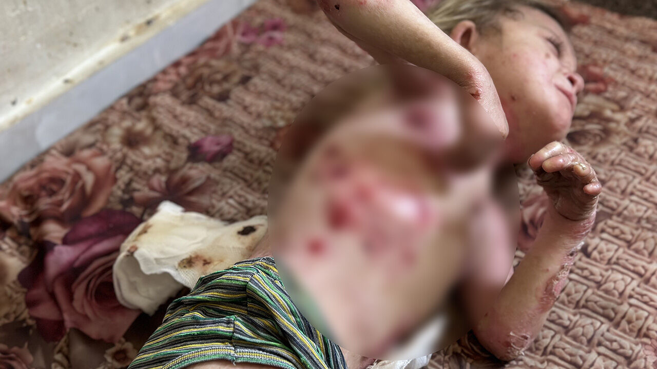 Gazze'de büyük dram! Kelebek hastası küçük kız tedavi olmayı bekliyor - 2. Resim